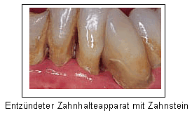 Entzündeter Zahnhalteapparat